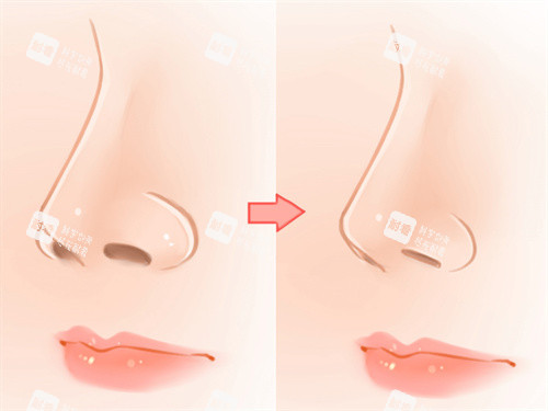 鼻尖矫正前后