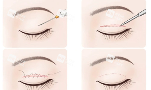 上海沈莺莺双眼皮做的好吗？从手术方案对比/术后反馈/2026价格表看其技术确实稳