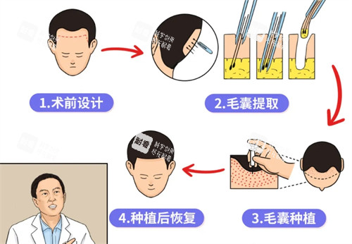植发手术的流程操作图