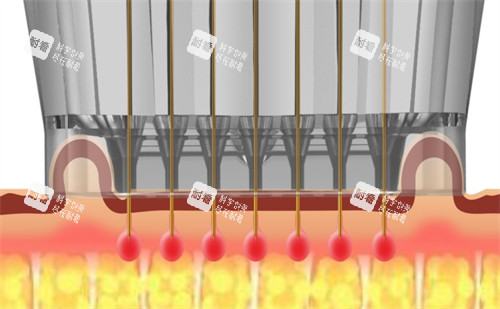 黄金微针施术过程