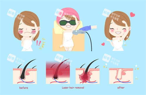 激光脱毛过程