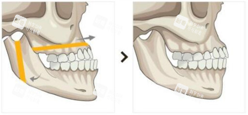 双鄂手术前后对比