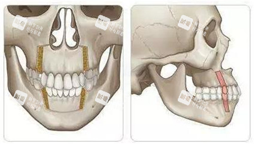 双鄂手术方式前方和侧方演示动画图