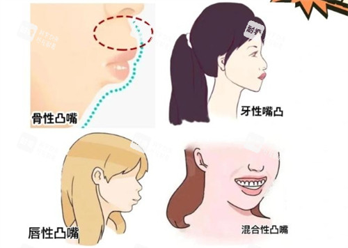 不同类型的凸嘴