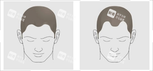 发际线对比 发际线对比