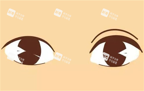 双眼皮手术的前后对比