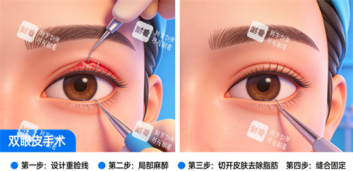 双眼皮手术过程解析 双眼皮手术过程解析