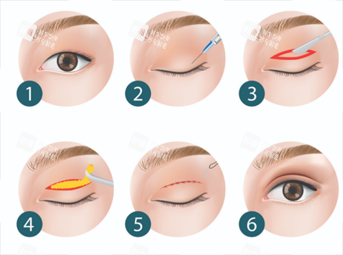 双眼皮步骤 双眼皮步骤