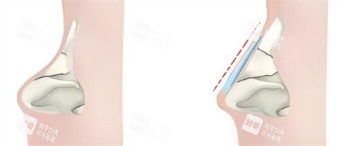 隆鼻超肋材料对比 隆鼻超肋材料对比