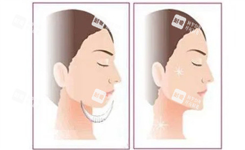 假体垫下巴 假体垫下巴