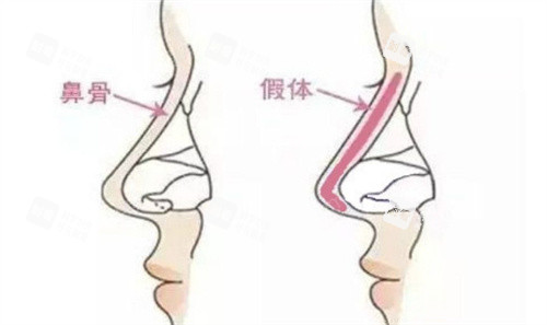 假体前后对比 假体前后对比