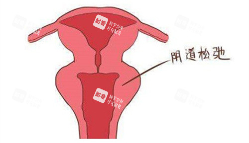 阴道松弛动画演示图