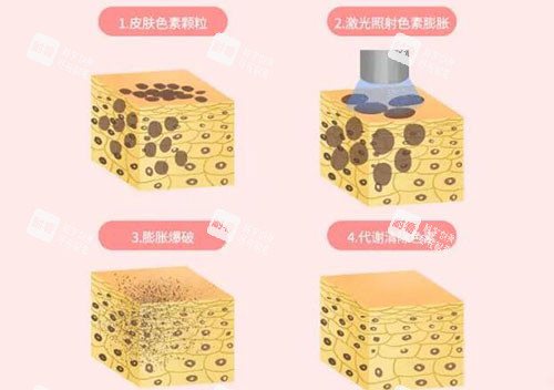 超皮秒皮肤改善原理