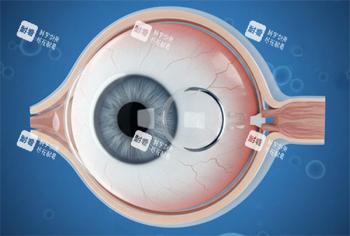 人工晶体植入手术