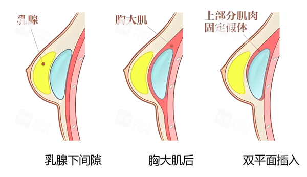 假体隆胸植入层次