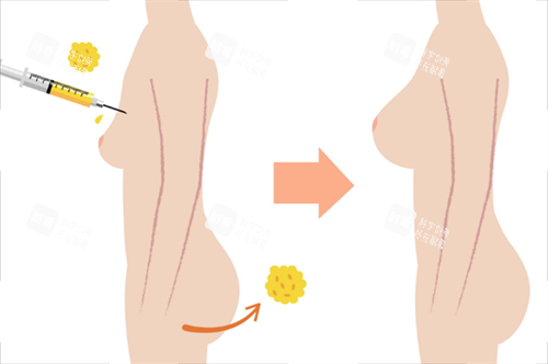 脂肪隆胸卡通图