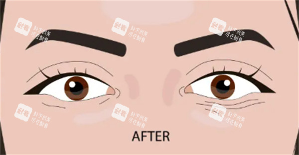 双眼皮手术后