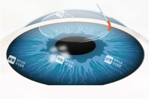 北京同仁医院王宁利出诊时间及预约攻略分享：在线可预约王宁利做近视矫正