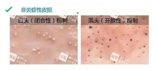 非炎症性闭口闭口黑口