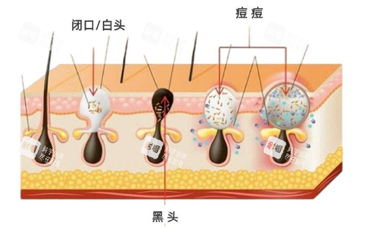 闭口黑头白头照片