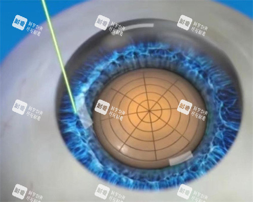 飞秒激光白内障手术图 飞秒激光白内障手术图