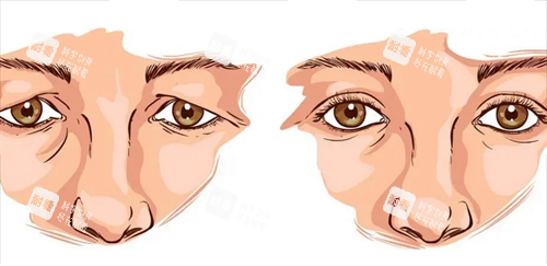 双眼皮修复前后 双眼皮修复前后
