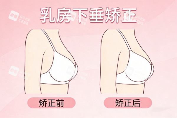 乳房下垂矫正前后对比图 乳房下垂矫正前后对比图