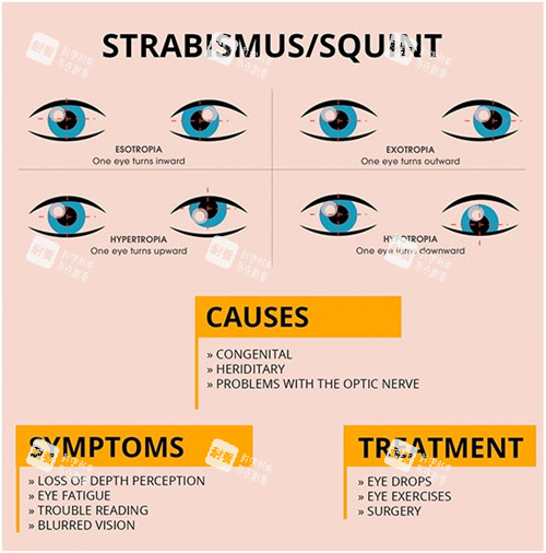 斜视手术介绍图