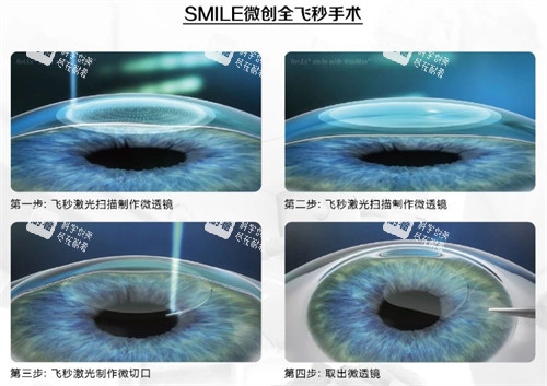 全飞秒手术过程