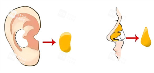 隆鼻耳软骨图示