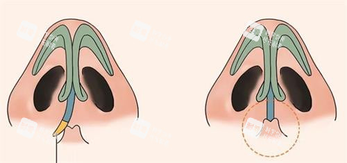 鼻中隔偏曲手术后的成效