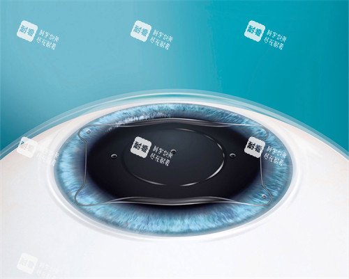 人工晶体植入眼睛后图示