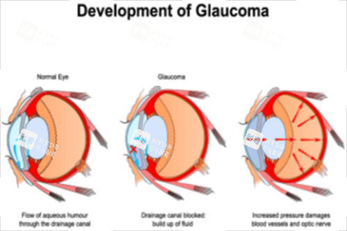 青光眼的形成