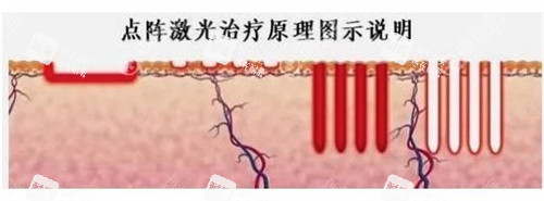 点阵激光祛疤