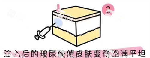 玻尿酸填充原理