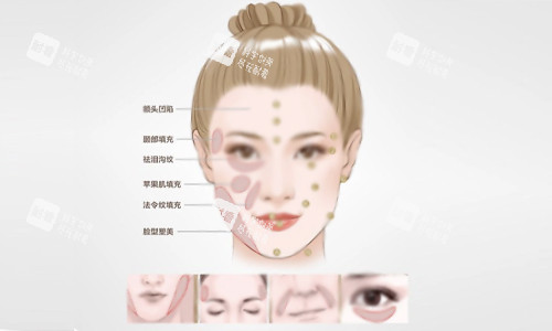 填充部位示意图