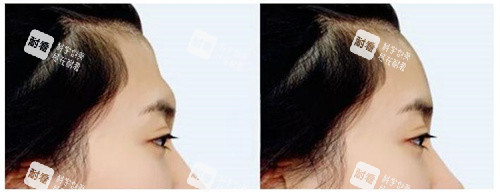 填充额头术后对比图