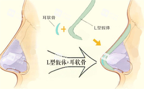 L形隆鼻假体