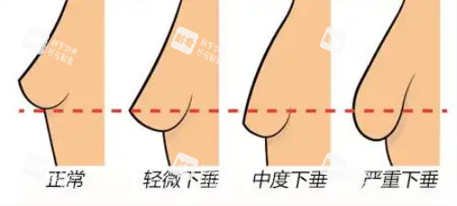 胸部下垂程度图片