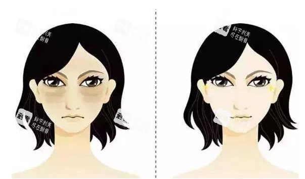 泪沟黑眼圈前后对比示意图