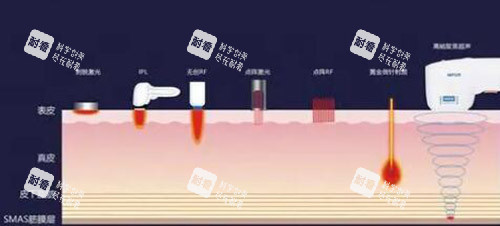 超声炮改善展示图照片