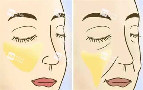 提升手术前后对比