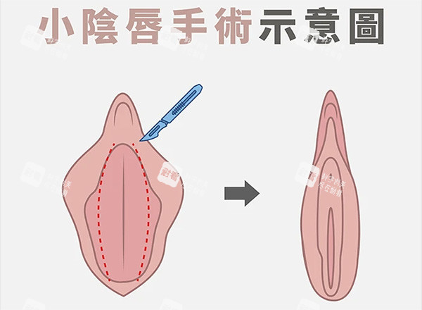 小阴唇整形前后对比