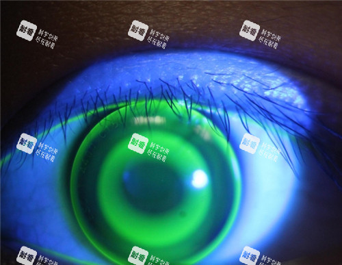 角膜塑形镜佩戴照片