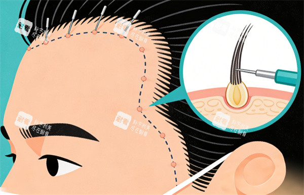 发际线种植手术卡通图