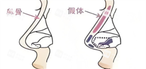 鼻综合假体植入