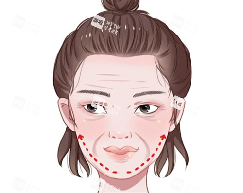 面部抗衰提升卡通图