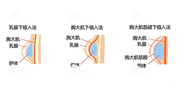 假体隆胸假体植入层次图