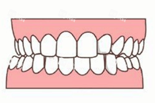 牙齿轻微畸形卡通图