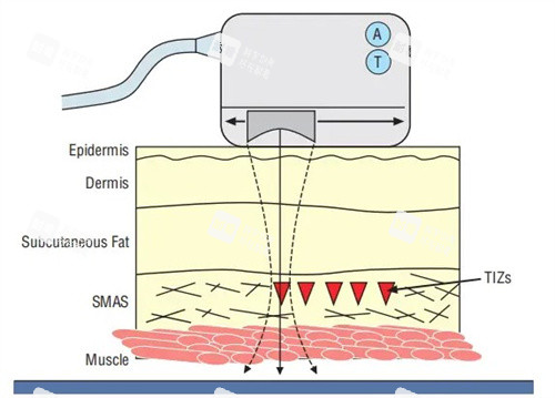 超声炮工作原理